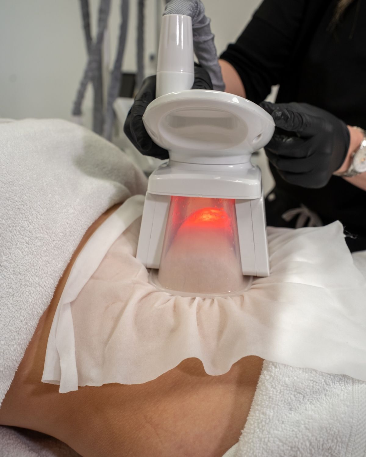 Types de services – Cryolipolyse