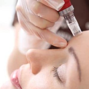 Régénérez votre peau avec le microneedling à Paris