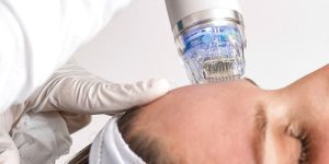 Микроигольчатый РФ